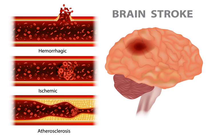 Hypertension and stroke