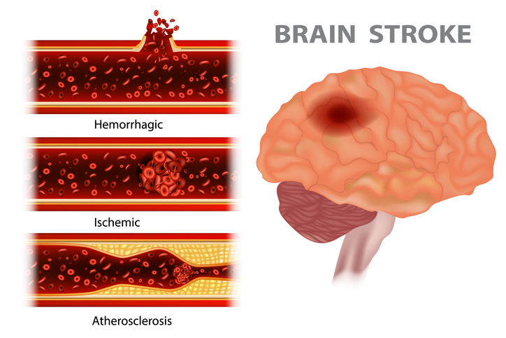 Complications of high blood outlet pressure